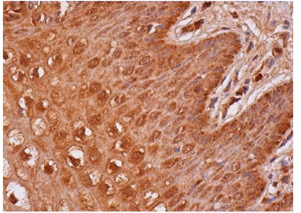  APC2 (L-17): sc-12425. Immunoperoxidase staining of formalin fixed, paraffin-embedded human vagina tissue showing cytoplasmic and membrane staining of squamous epithelial cells. 