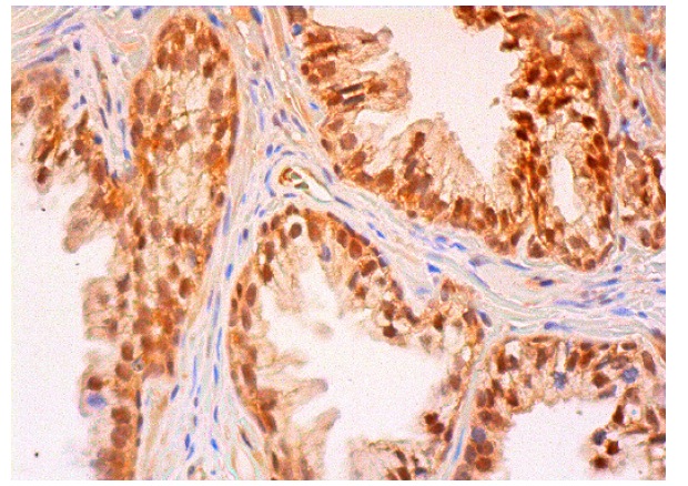  Bcl-9 (H-250): sc-68915. Immunoperoxidase staining of formalin fixed, paraffin-embedded human prostate tissue showing nuclear staining of glandular cells.