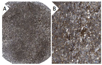  CUL-7 (AB38): sc-53810. Immunoperoxidase staining of formalin fixed, paraffin-embedded human lymph node tissue showing cytoplasmic staining of lymphoid cells (low and high magnification). Kindly provided by The Swedish Human Protein Atlas (HPA) program.