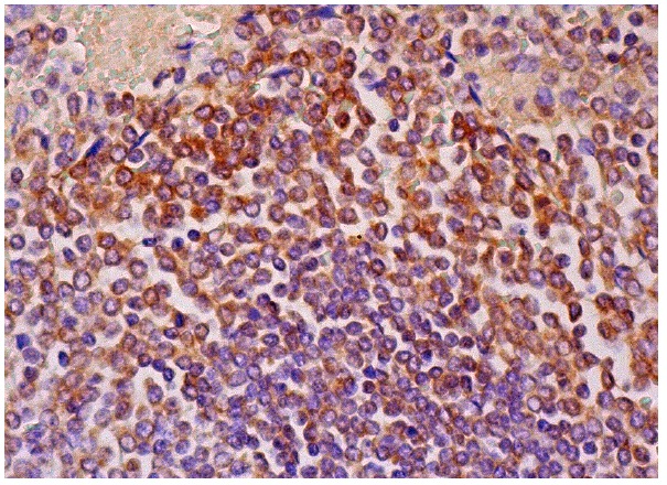  p-Bcl-2 (74.Ser 70): sc-135757. Immunoperoxidase staining of formalin fixed, paraffin-embedded human spleen tissue showing cytoplasmic staining of cells in white pulp.