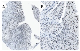  NIFK (18E148): sc-52904. Immunoperoxidase staining of formalin fixed, paraffin-embedded human urinary bladder tissue showing nucleolar staining of urothelial cells (low and high magnification). Kindly provided by The Swedish Human Protein Atlas (HPA) program.