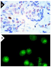  p21 (F-5): sc-6246. Immunoperoxidase staining of formalin-fixed, paraffin-embedded human breast carcinoma tissue showing nuclear staining of select cells (A). Immunofluorescence staining of methanol-fixed knrk cells showing nuclear localization (B).