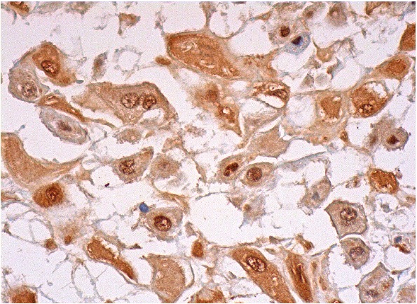  p57 (E-17): sc-1037. Immunoperoxidase staining of formalin fixed, paraffin-embedded human placenta tissue showing nuclear and cytoplasmic staining of decidual cells.