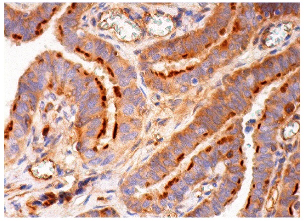  Rootletin (H-84): sc-135275. Immunoperoxidase staining of formalin fixed, paraffin-embedded human fallopian tube tissue showing cytoplasmic staining of ciliated cells.