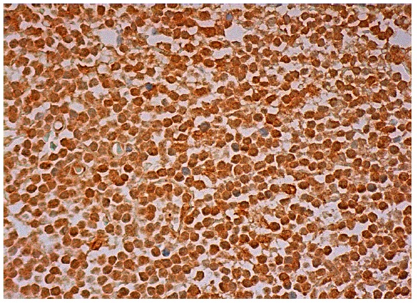  Spc25 (C-15): sc-69332. Immunoperoxidase staining of formalin fixed, paraffin-embedded human lymph node tissue showing nuclear staining of cells in germinal centers and cells in non-germinal centers.