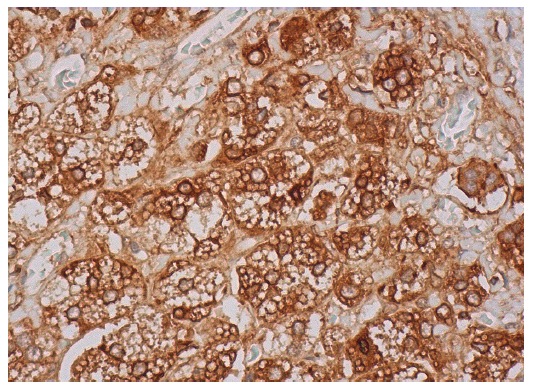  BRCA2 (I-17): sc-1818. Immunoperoxidase staining of formalin fixed, paraffin-embedded human adrenal gland tissue showing cytoplasmic, membrane and nuclear staining of glandular cells.