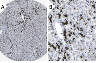  Alix (1A12): sc-53540. Immunoperoxidase staining of formalin fixed, paraffin-embedded human liver tissue showing cytoplasmic staining of hepatocytes (low and high magnification). Kindly provided by The Swedish Human Protein Atlas (HPA) program.