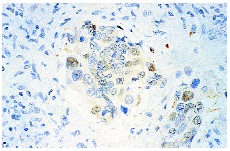  CAS (C-20): sc-1708. Immunoperoxidase staining of formalin-fixed, paraffin-embedded human liver tumor showing staining associated with select nuclei. 