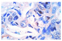  CAS (N-19): sc-1709. Immunoperoxidase staining of formalin-fixed, paraffin-embedded human liver tumor showing selective cell staining.