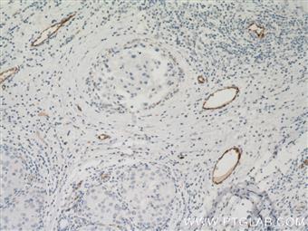  Immunohistochemistry of paraffin-embedded human breast cancer tissue slide using 66682-1-Ig (vwf antibody) at dilution of 1:500 (under 10x lens) heat mediated antigen retrieved with Tris-EDTA buffer(pH9).