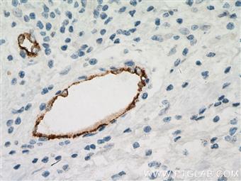  Immunohistochemistry of paraffin-embedded human breast cancer tissue slide using 66682-1-Ig (vwf antibody) at dilution of 1:500 (under 40x lens) heat mediated antigen retrieved with Tris-EDTA buffer(pH9).