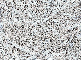  Immunohistochemistry of paraffin-embedded human colon cancer tissue slide using 66621-1-Ig (XRCC4 antibody) at dilution of 1:500 (under 10x lens) heat mediated antigen retrieved with Tris-EDTA buffer(pH9).